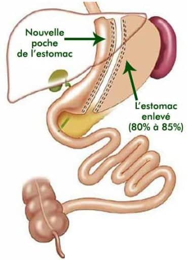 sleeve gastrique
